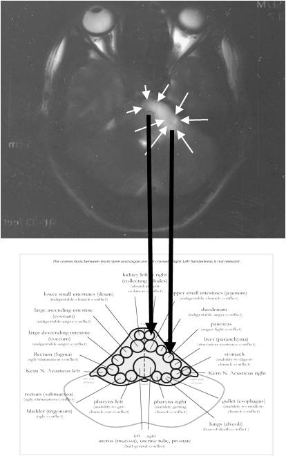 Brain tumour MRI Brain tumour MRI